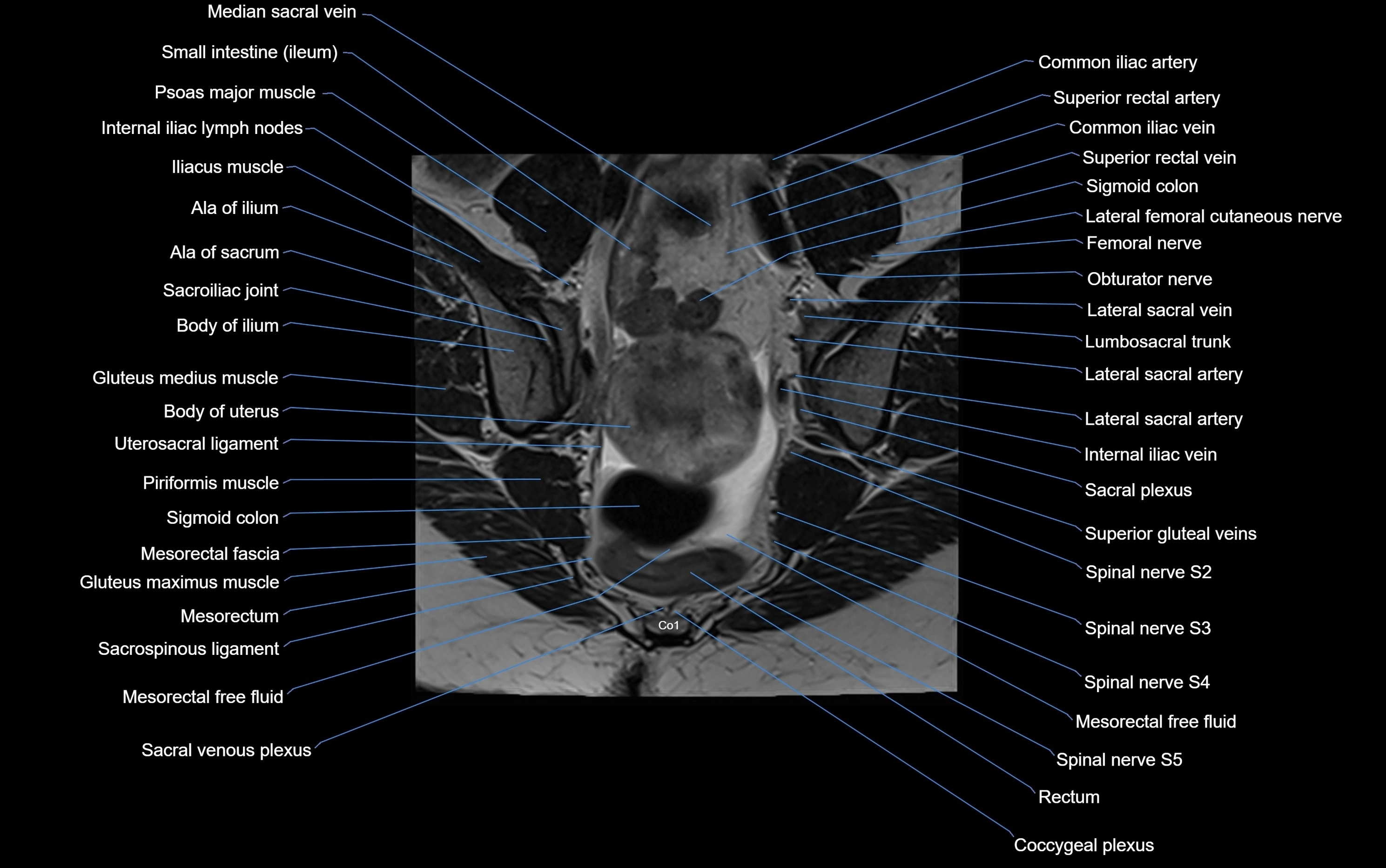 MRI sacroiliac joint coronal cross sectional anatomy  radiology  image-img-00001-00010.webp